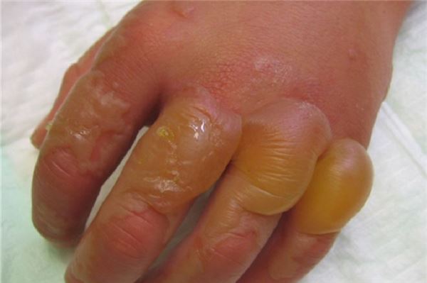 Verbrennungen ersten und zweiten Grades sind das Resultat einer Berührung der Haut mit der Herkulesstaude. Häufig bleiben Narben zurück. Foto: Landratsamt Unterallgäu